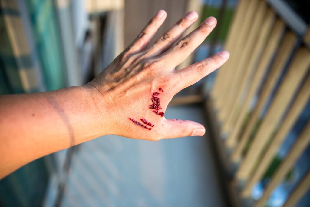Dog Bites - -